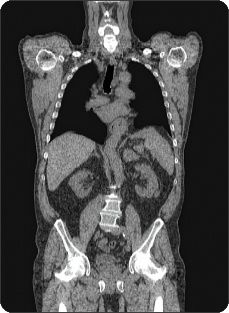 Ct scan